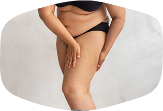 Erfahrungen vor und nach der Liposuktion: Was gilt es zu beachten?